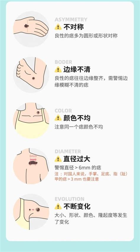 手臂很多痣|痣也可能会癌变！长在 3 个地方要注意